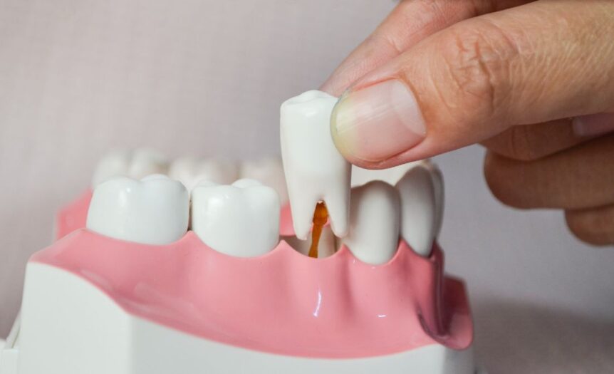 What To Eat Following Your Tooth Extraction